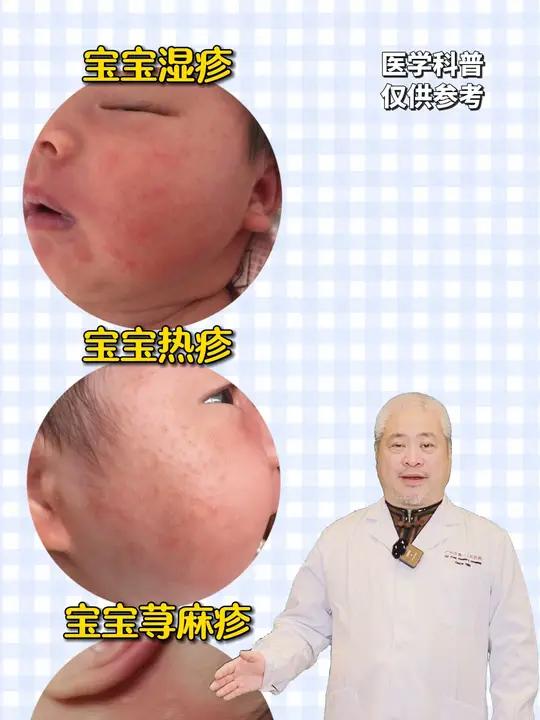 宝宝常见的三种小疹子,一个视频教你处理!