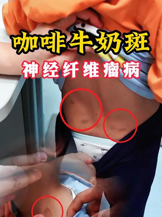 咖啡牛奶斑 神经纤维瘤病导致脊柱侧弯