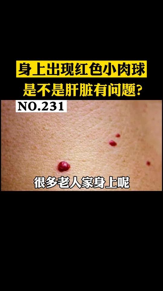 身上长了红色的小肉球,看起来像红痣一样,这个是代表肝脏有问题吗?