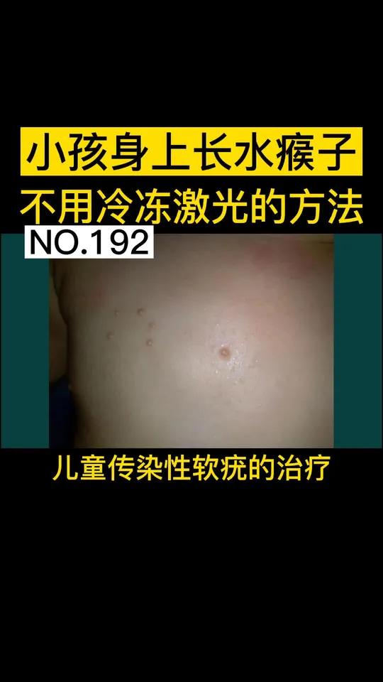 小孩身上水瘊子传染性软疣,不想激光冷冻怎么办?这个视频帮到你