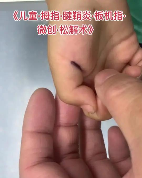 儿童大拇指腱鞘炎不能伸直 不能顶呱呱?1岁以下大多可以缓解,针对3岁以上长时间不能关节弯曲