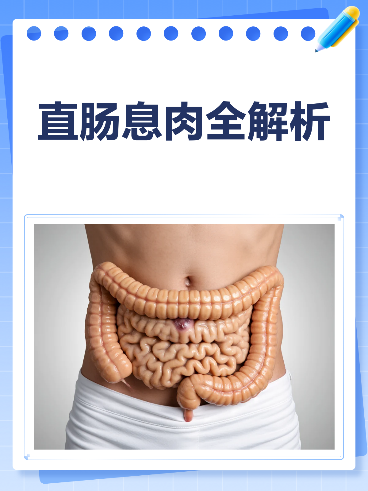 直肠息肉全解析:从定义到治疗,一文读懂!
