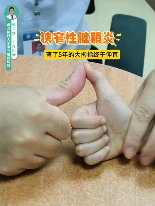 狭窄性腱鞘炎 弯曲了5年的大拇指终于伸直了。狭窄性腱鞘炎会让孩子的手指不能伸直,手指上有个