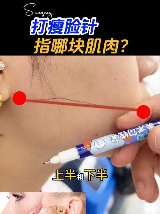 瘦脸针作用部位，一般是这一处肌肉 瘦脸针打哪个部位 注射瘦脸 瘦脸针的副作用