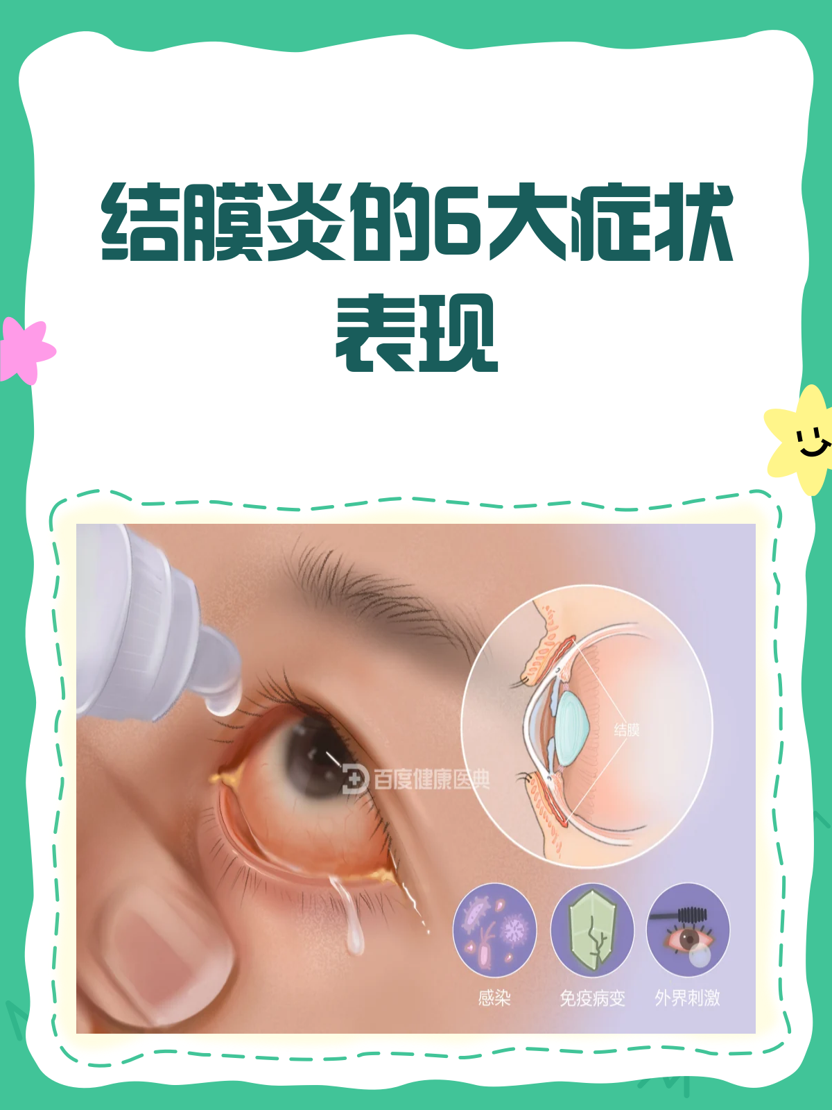 结膜炎症状大揭秘!你的眼睛可能在说话