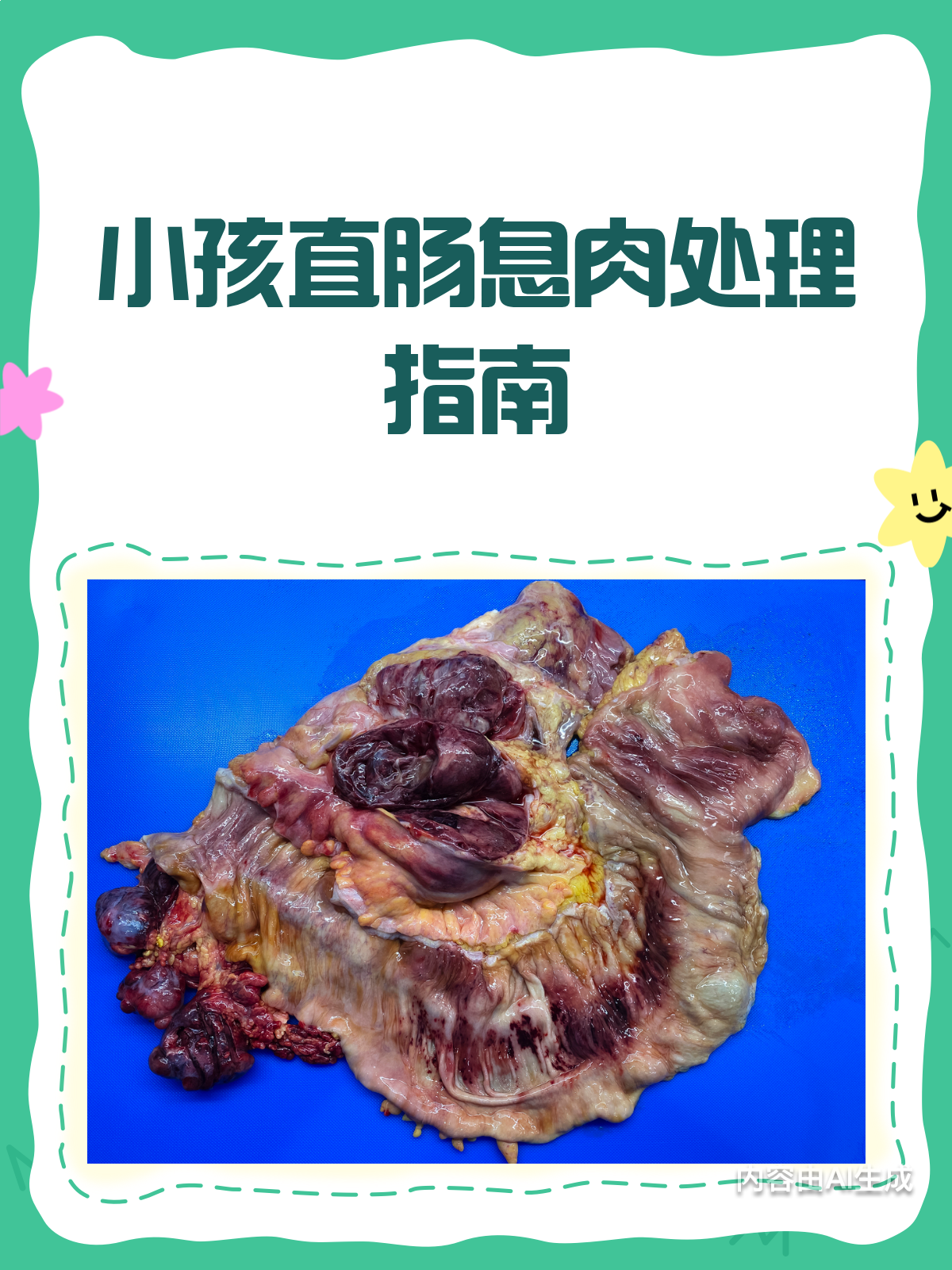 孩子得了直肠息肉怎么办?来帮忙!