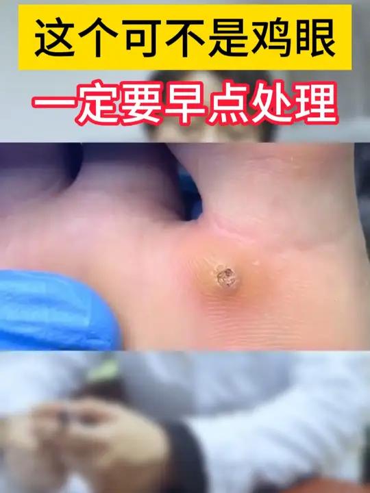 这个可不是鸡眼,一定要早点处理