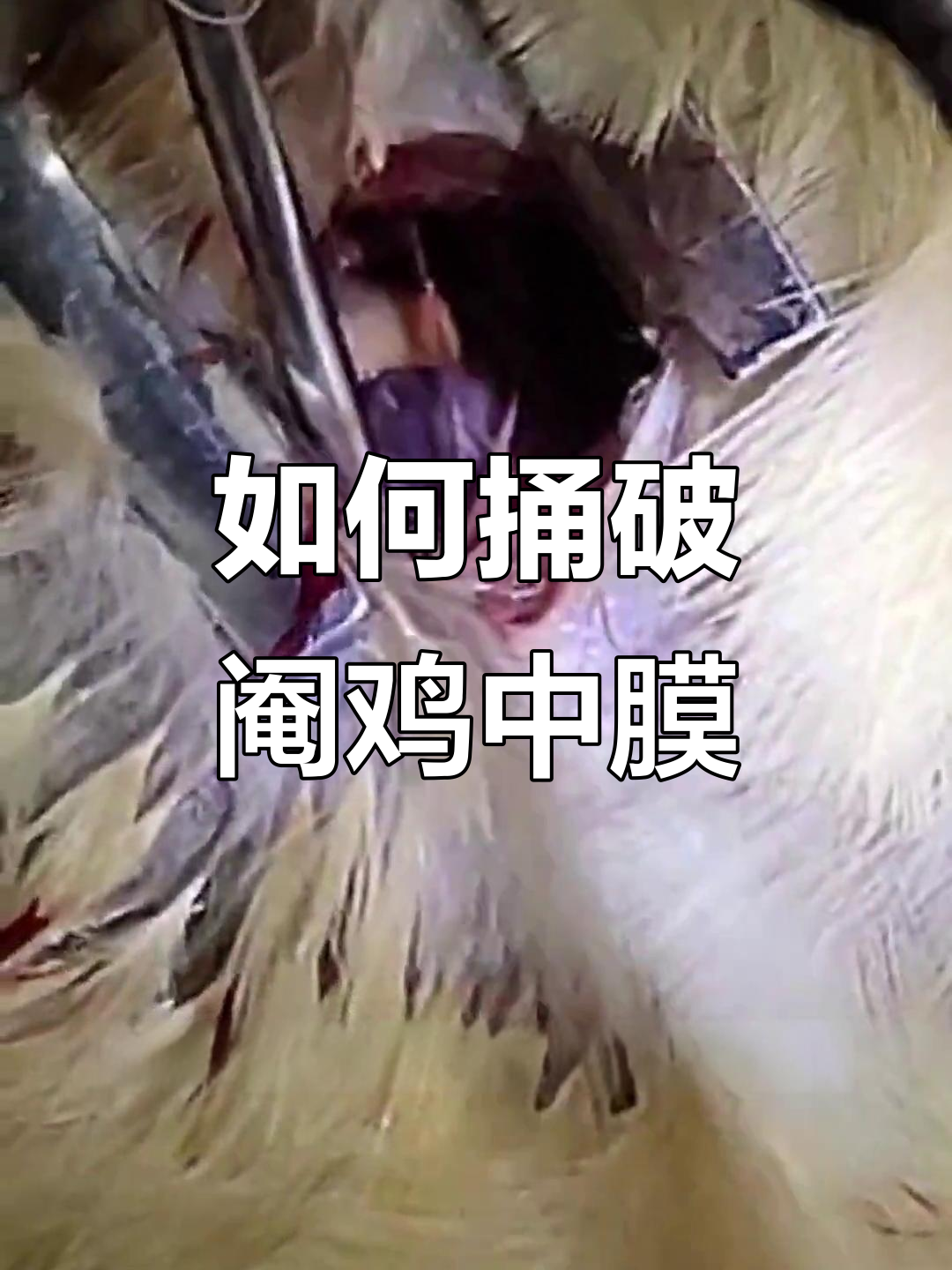 破阉鸡中膜的技巧，轻松搞定血管问题