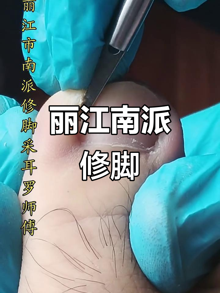丽江南派修脚:传统技艺与现代解压的完美结合