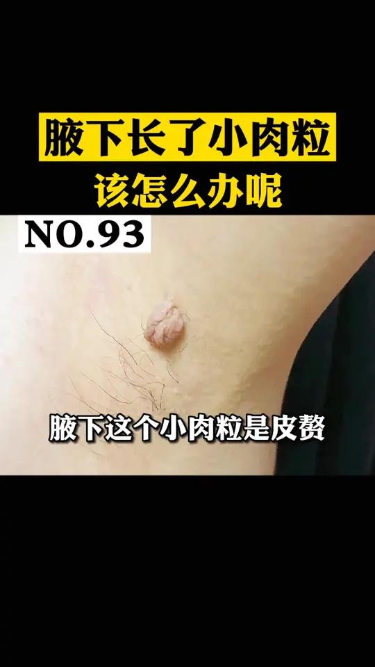 腋下长了这种小肉粒,该如何处理呢