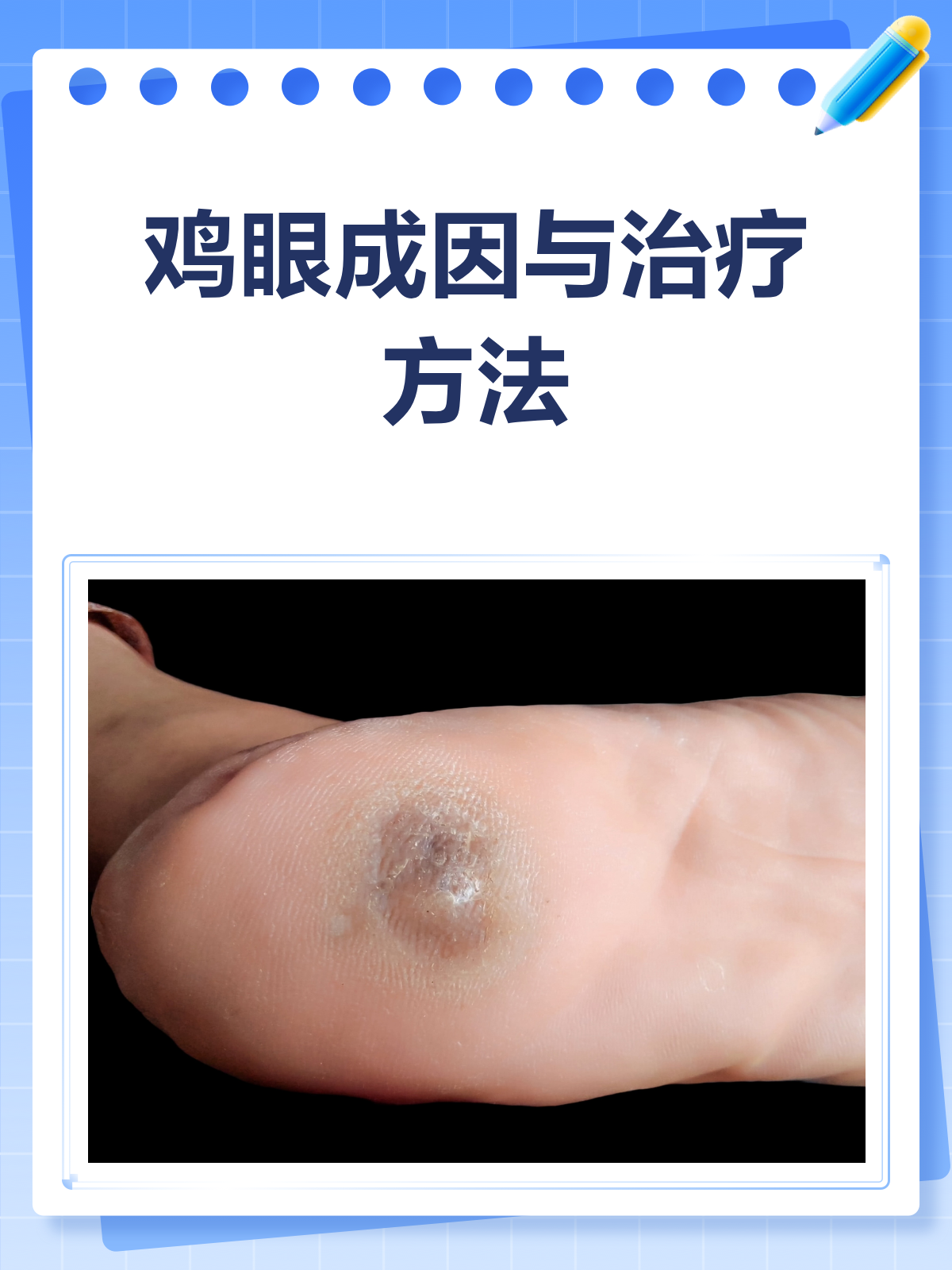 鸡眼烦恼?一文告诉你原因与治疗方法!