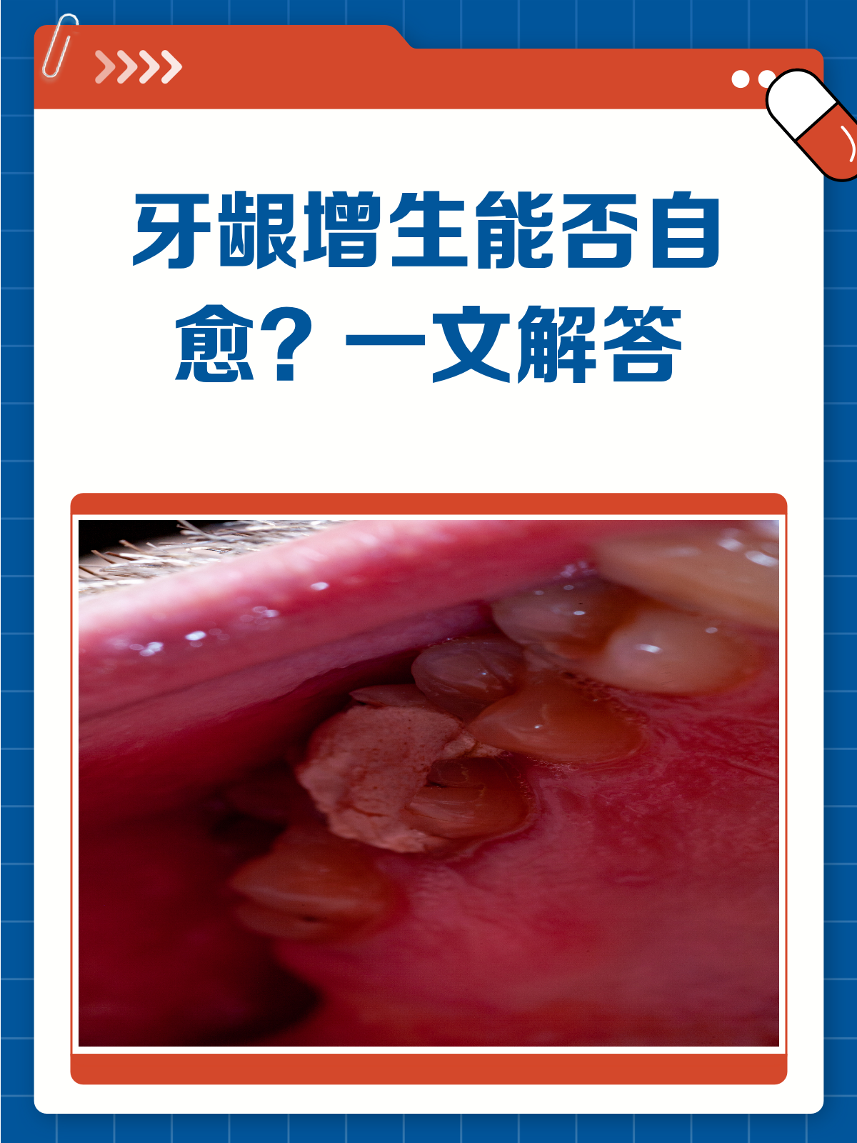 牙龈增生能不能自愈?看完这篇就懂了!