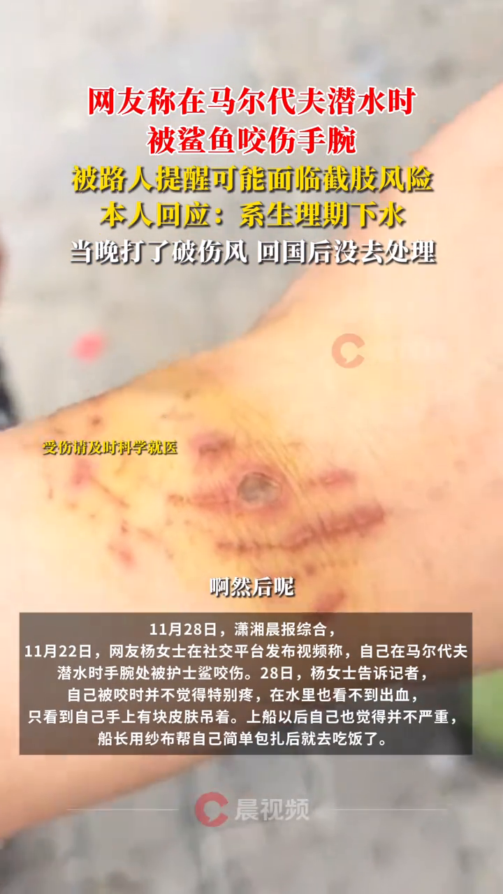 网友称生理期在马尔代夫潜水时被鲨鱼咬伤手腕