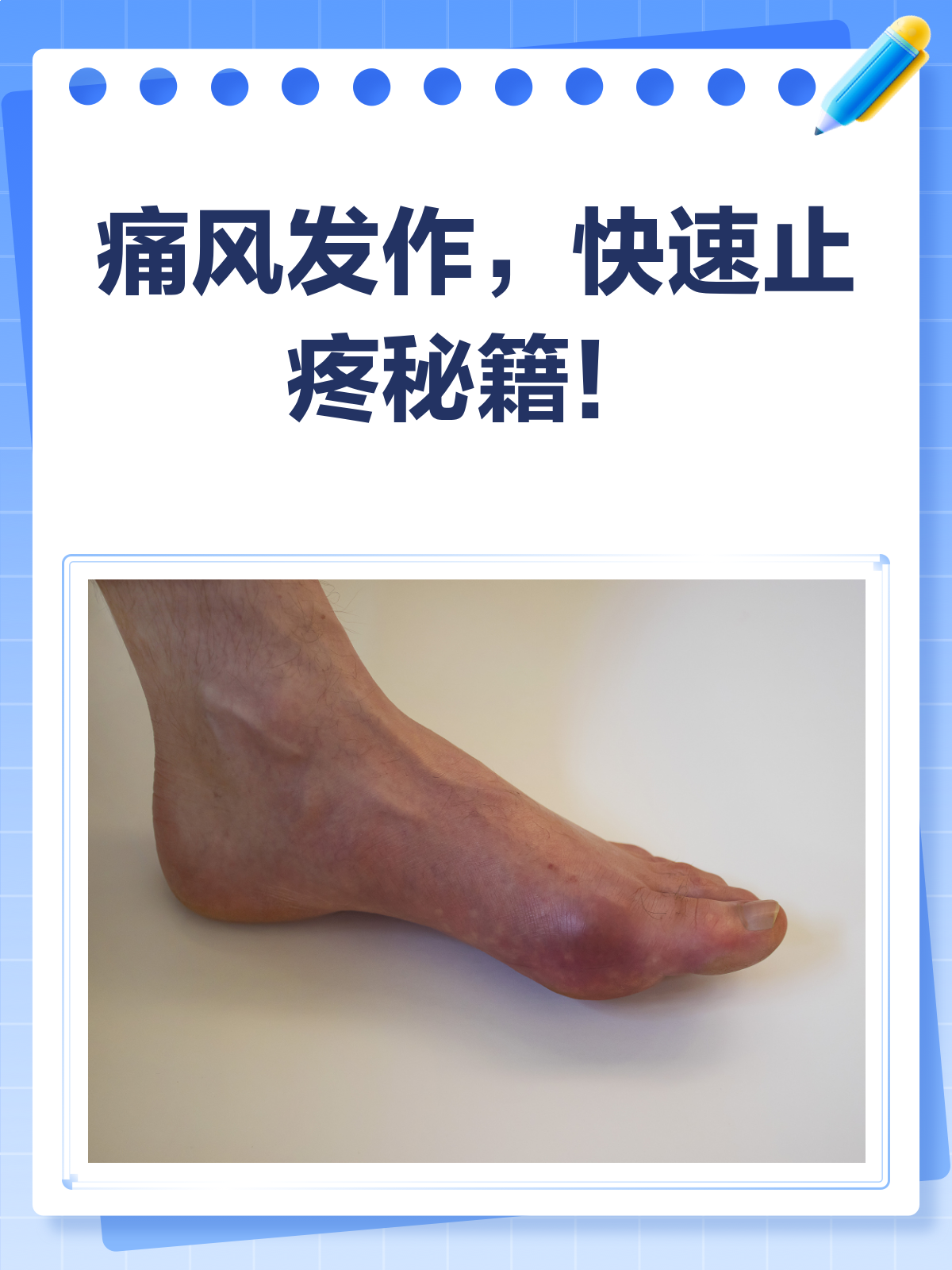痛风来袭痛不欲生?快速止疼秘籍来啦!