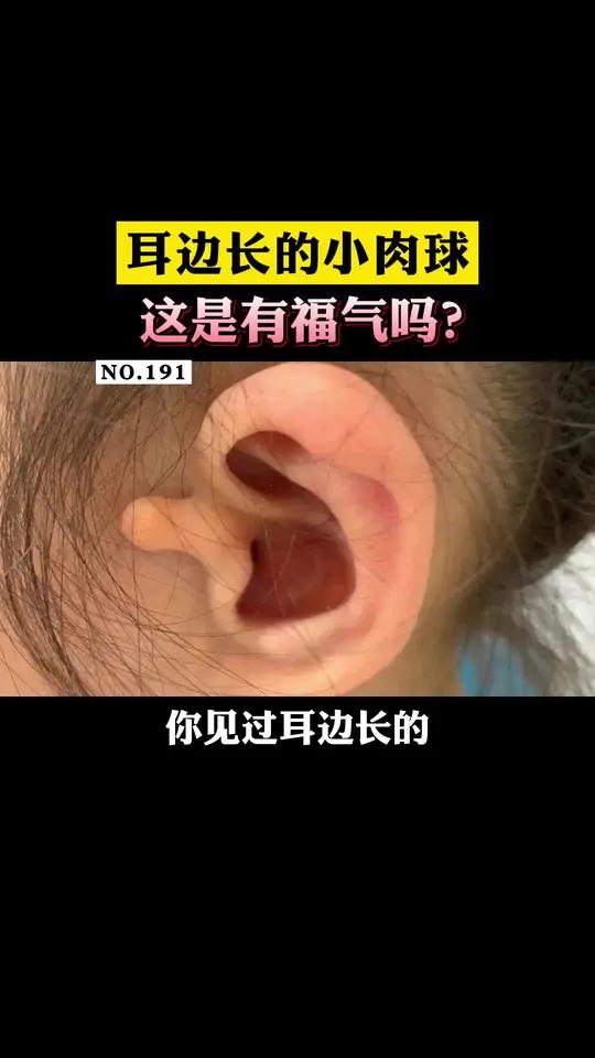 耳朵旁边长小肉球,这是有福气的象征吗