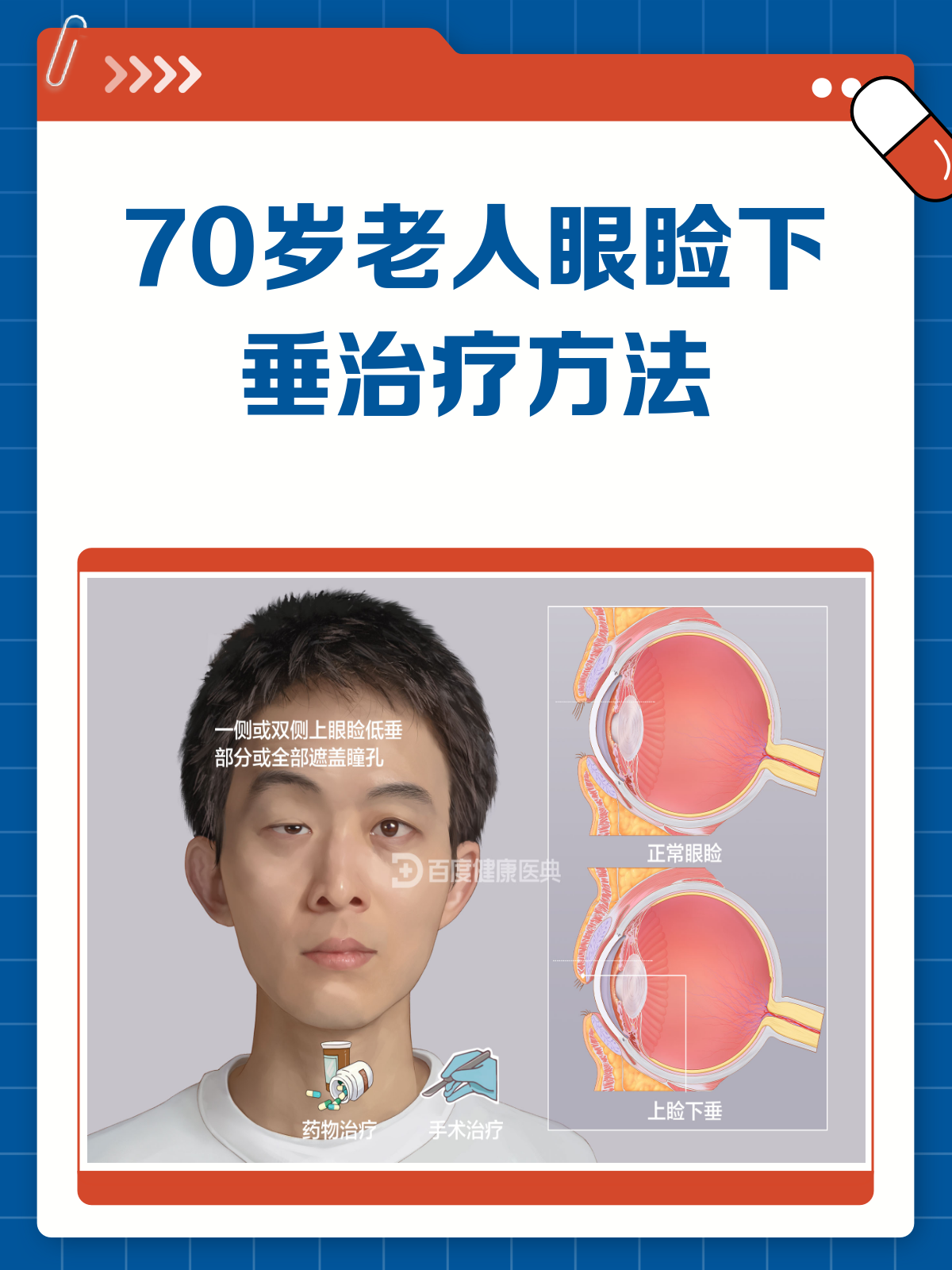 70岁老人眼睑下垂怎么办?这些方法值得一试!