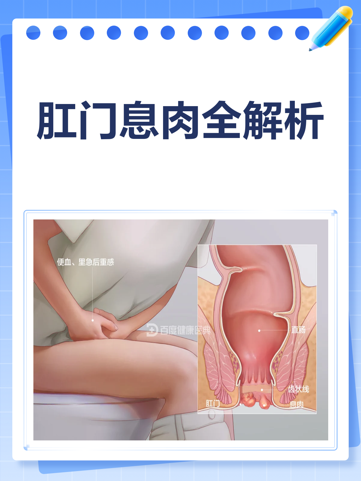 肛门息肉知多少?一文带你全面了解