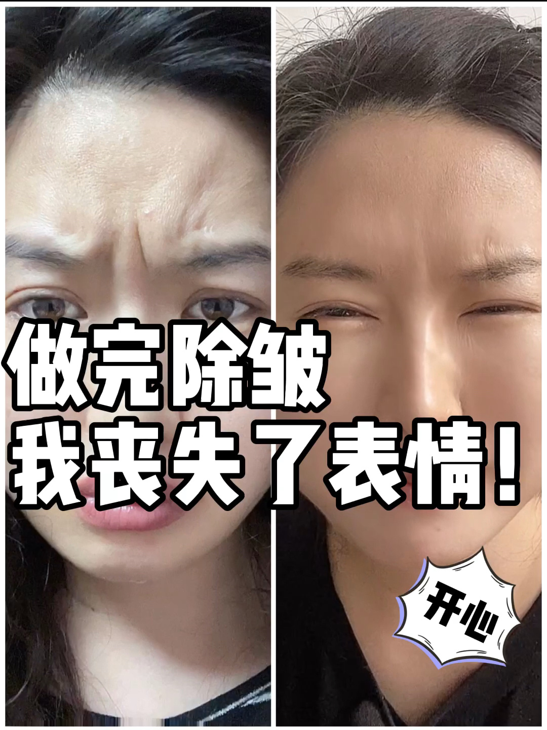 打肉毒素除皱一周后效果对比,并分析利弊