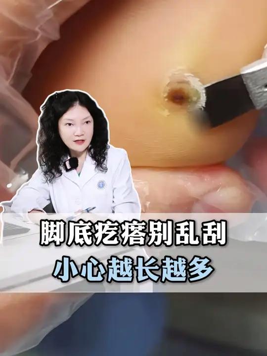 脚上疙瘩别刮，更别抠，这是病毒感染！医生教你正确处理#跖疣 #HPV #鸡眼 #传染 #抖
