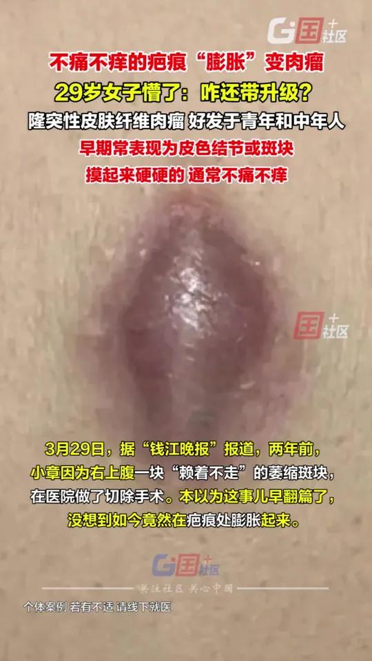 不痛不痒的疤痕疙瘩变肉瘤,29岁女子懵了:“这瘢痕疙瘩怎么还带升级的?”医生:隆突性皮肤纤