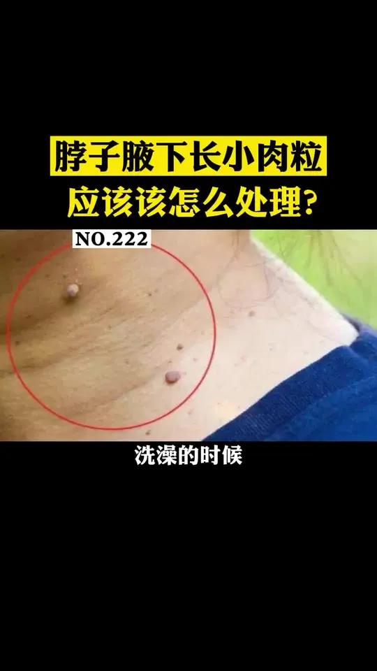 脖子或腋窝处长了肉色或褐色的小肉球,这是软纤维瘤,不要与丝状疣弄混了,其实处理起来很简单!