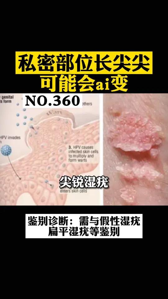 私密部位长了像菜花、鱼卵样的东西,不要拖着,还是要及早去看看科普皮肤 尖锐湿疣