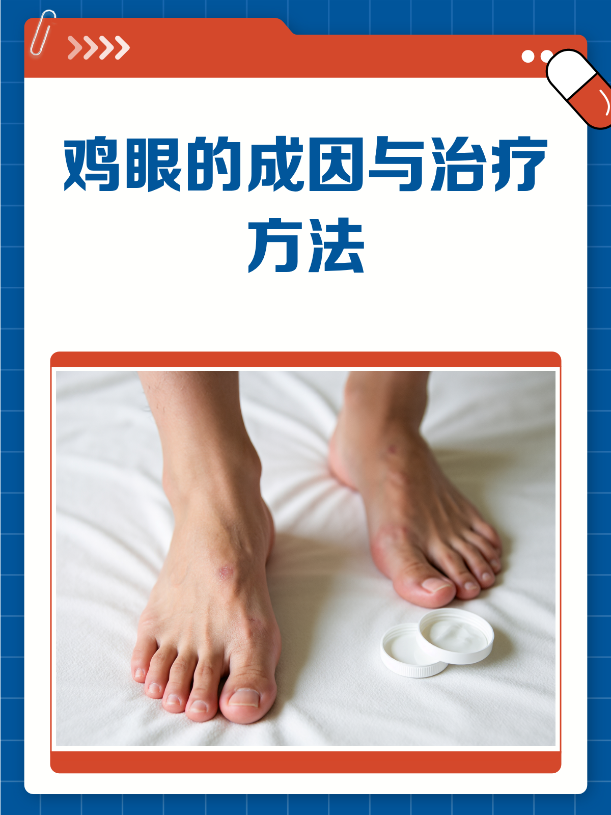 鸡眼烦恼?一文告诉你原因与治疗方法