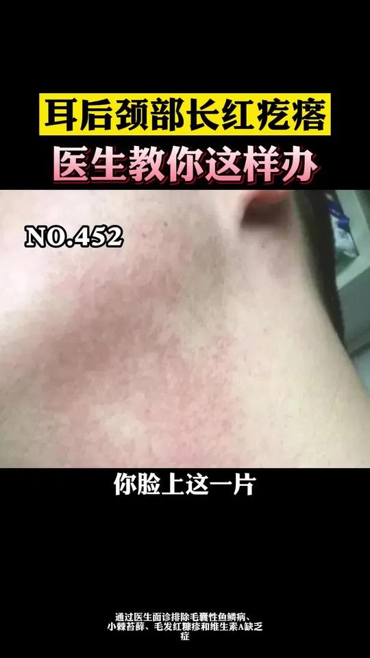 面颈部的小疙瘩其实不一定是鸡皮肤,可能是面颈毛囊性红斑黑变病,可以这么办