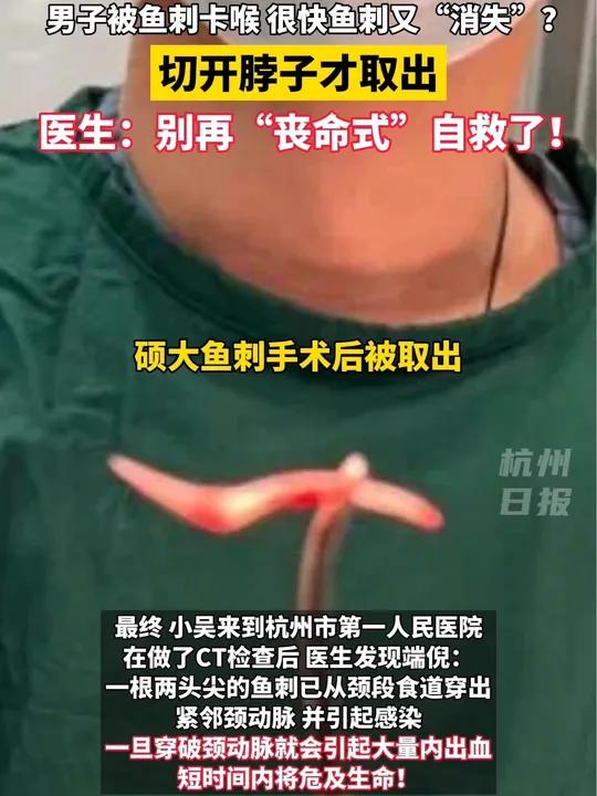 男子被鱼刺卡喉切开脖子才取出 什么是“消失的鱼刺”?医院:别再丧命式自救了!鱼刺 杭州