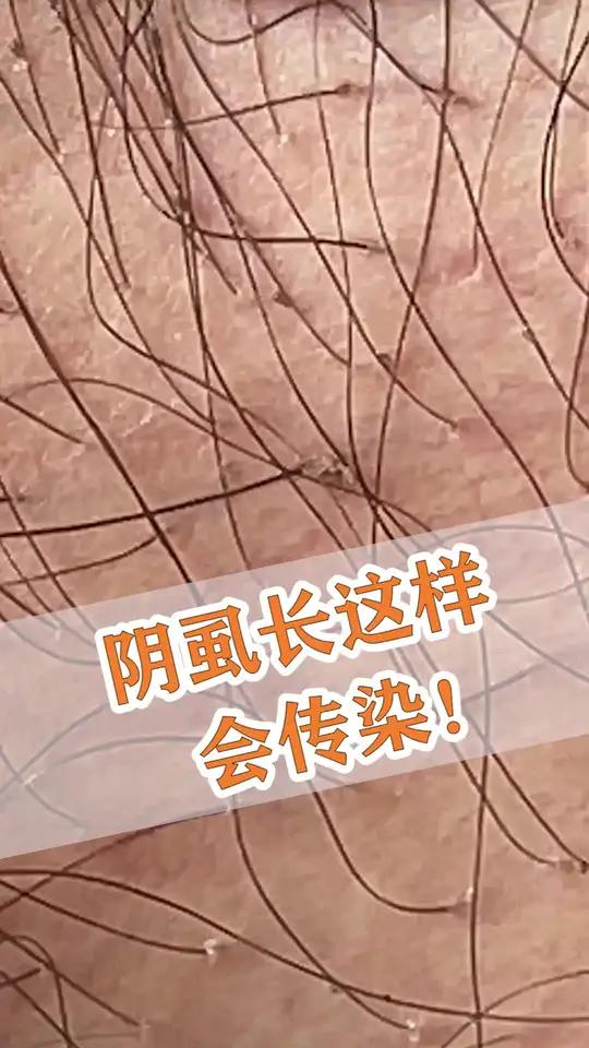 虱子长这样,会传染,记得剃毛+清洗!