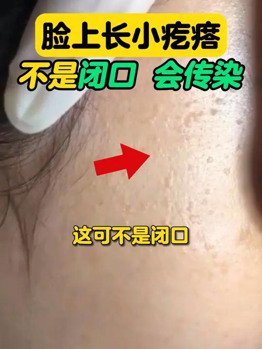 这不是闭口!脸上扁平的褐色小疙瘩,可能是hpv感染引起的扁平疣,不要去抓,可能会越长越多!