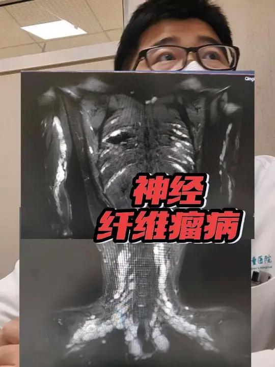 神经纤维瘤病,丛状 #儿外科医生徐升 #徐升 #神经纤维瘤病 #咖啡牛奶斑 #神经纤维瘤