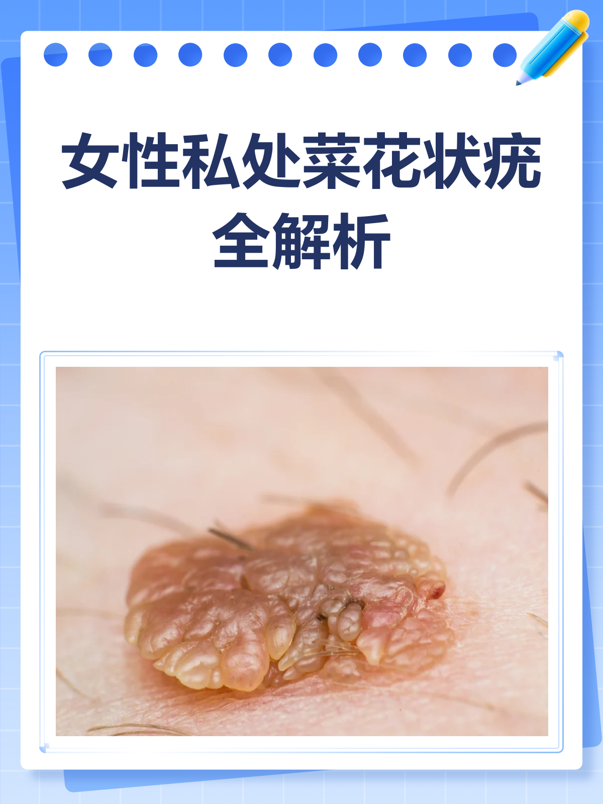 发现私处菜花状疣？别慌，先了解这些！