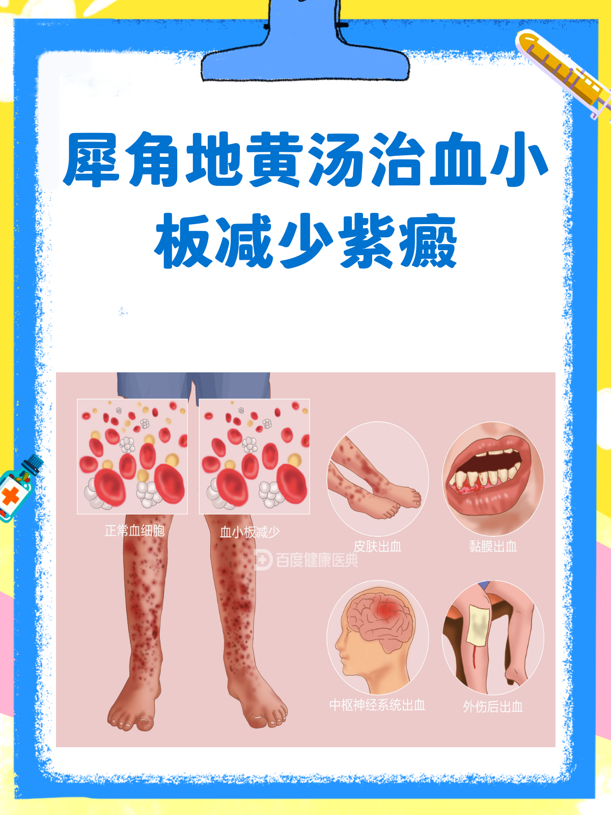 犀角地黄汤，血小板减少紫癜的中医良策？