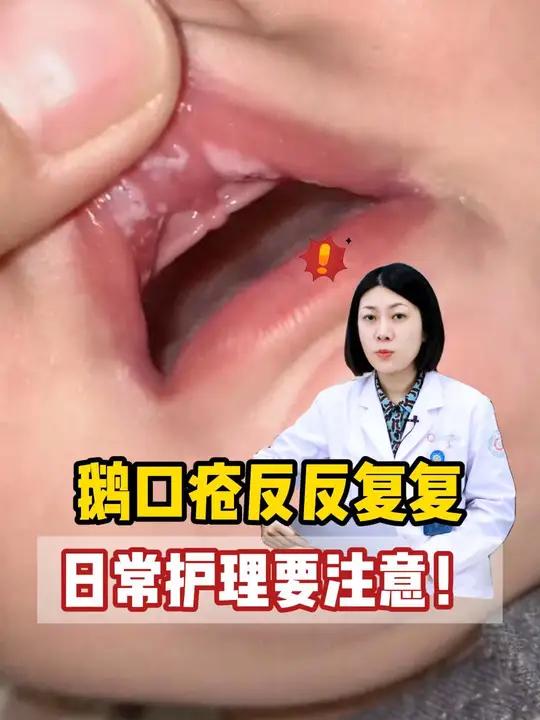 日常这几点没注意,难怪宝宝鹅口疮总是反反复复!