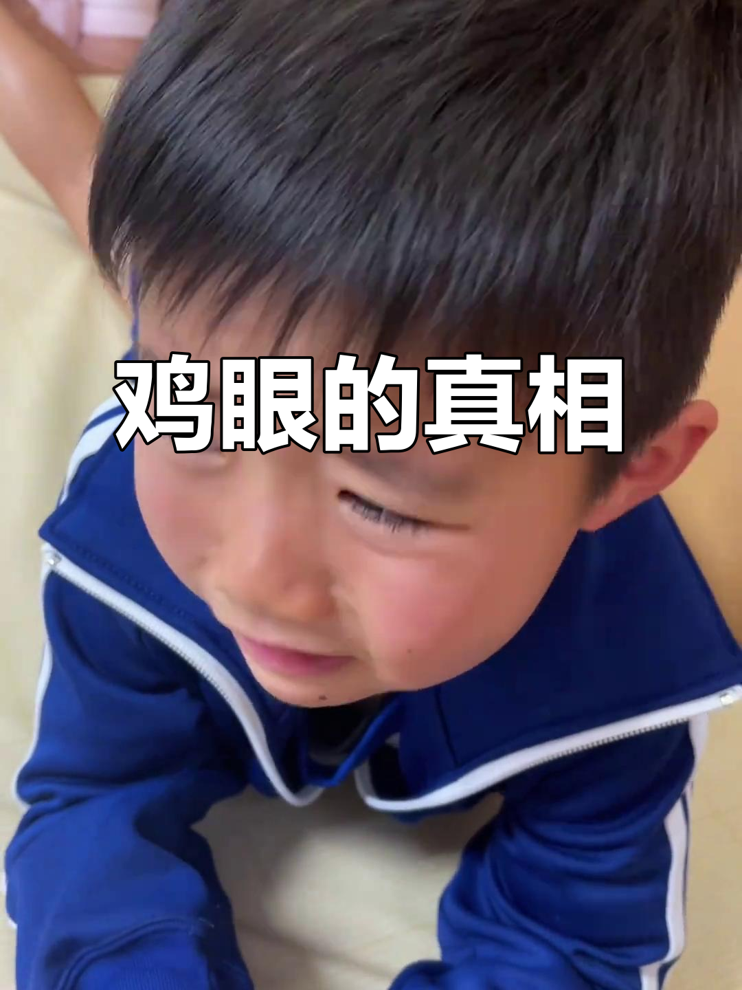 小孩子脚底长鸡眼,原来是细菌感染引起的