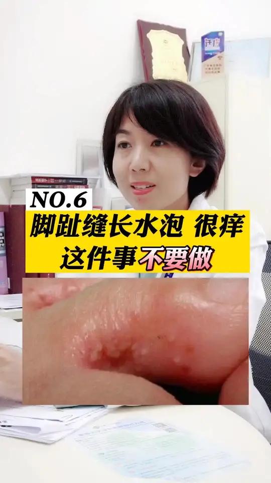 足癣也就是大家俗称的脚气,像这种脚趾缝里长水泡,又痒又臭,这件事可不要做了!