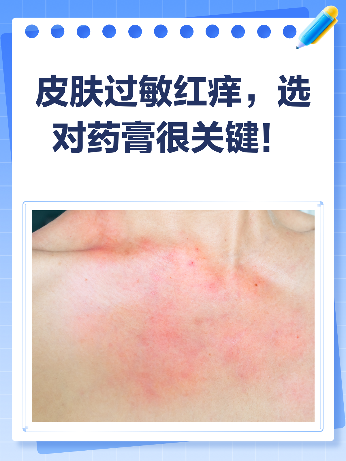 皮肤过敏大面积红痒?这些药膏来帮忙