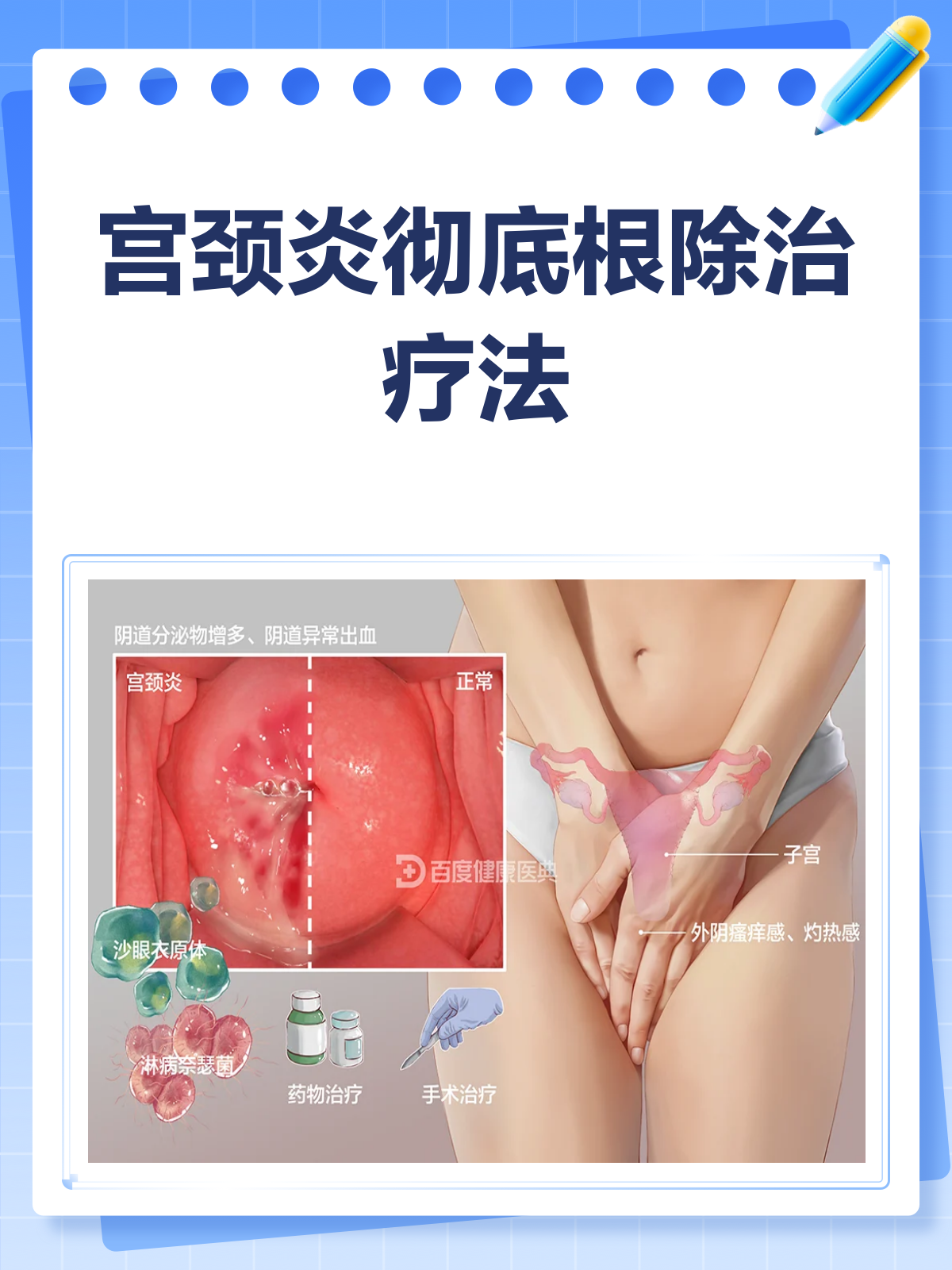 宫颈炎怎么治?这份指南请收好