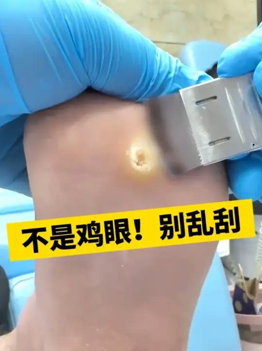 这可不是鸡眼,别再用刀刮了,当心越长越多!