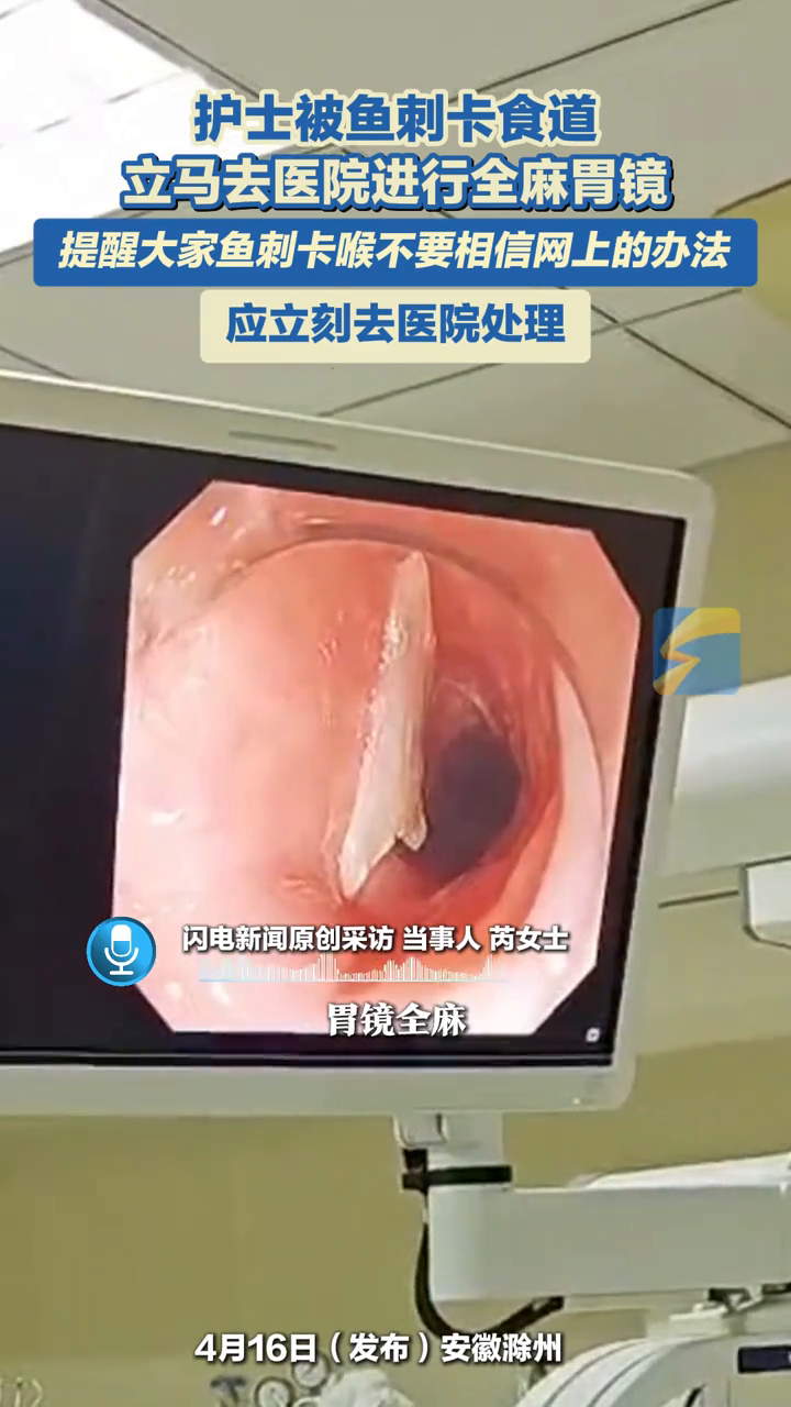 护士被鱼刺卡食管,立马去医院进行全麻胃镜