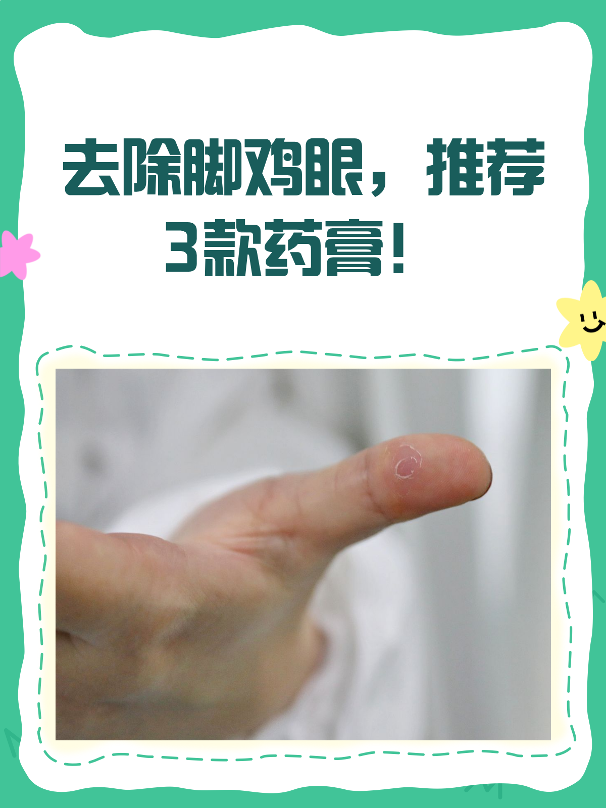 告别脚鸡眼,这些药膏来帮忙!