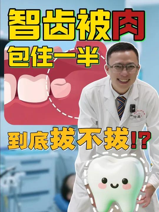智齿被肉包住了一半要不要拔?看完这个视频你就知道了