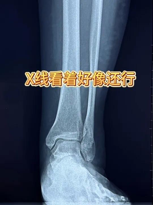 X线一般只能观察骨头的基本形态,诊治可能还要做负重CT 医学科普负重CT医学影像 负重CT