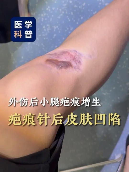 外伤后小腿疤痕增生,疤痕针后皮肤凹陷