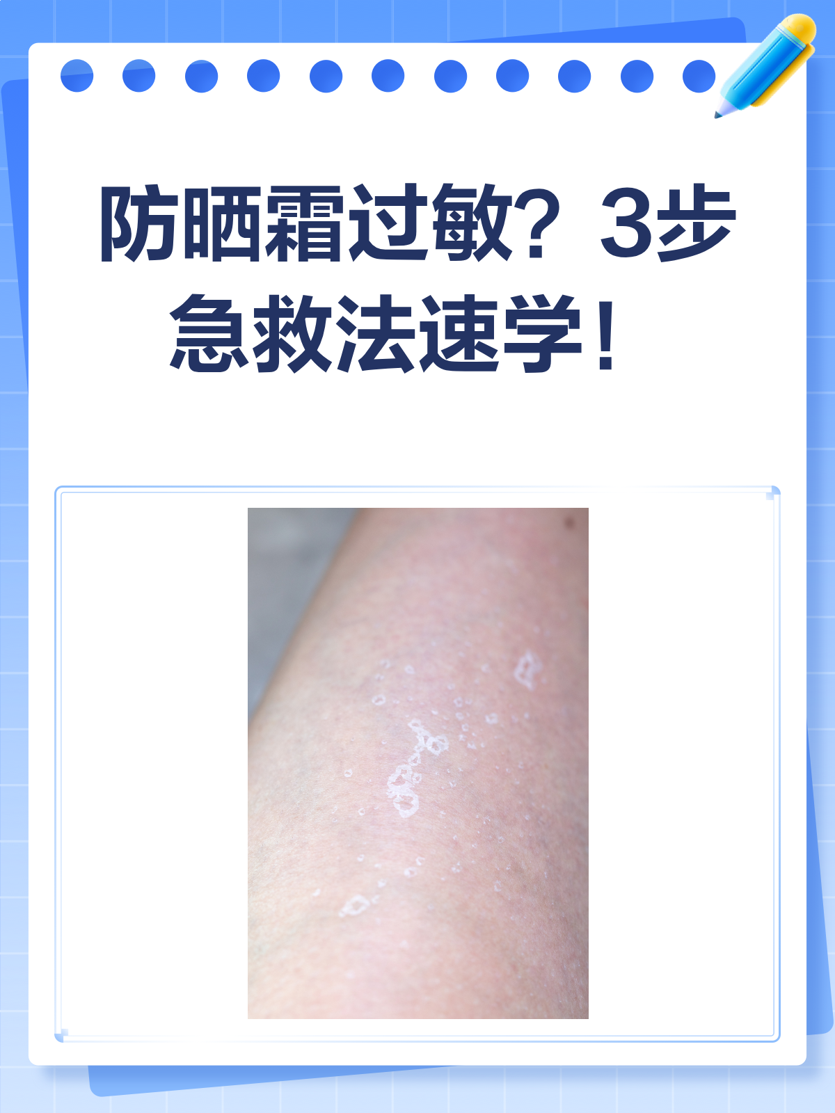 防晒霜过敏怎么办?3步急救法教你轻松应对!