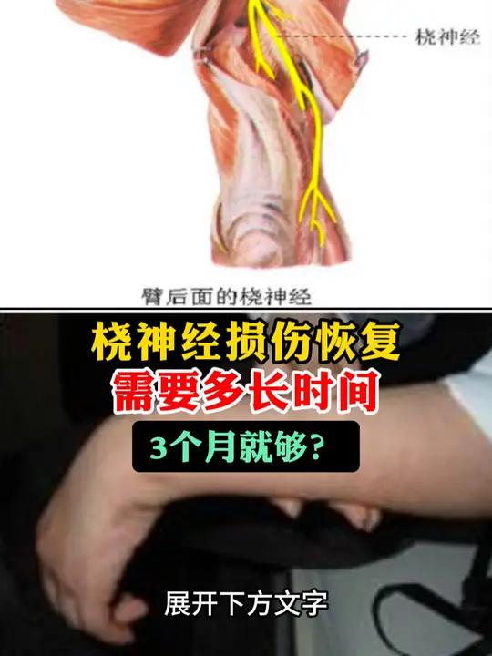 当我们的桡神经受到损伤时,会导致手腕和手指的功能受限。桡神经损伤的恢复时间因个体差异和损伤