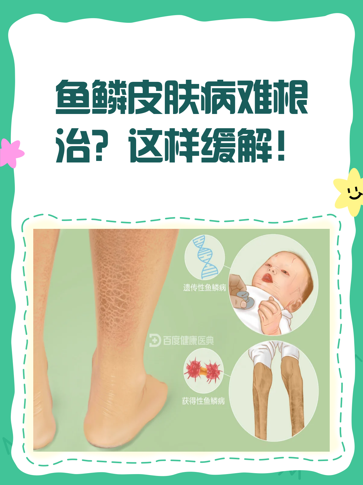 鱼鳞皮肤病能根治吗?来看专业解答