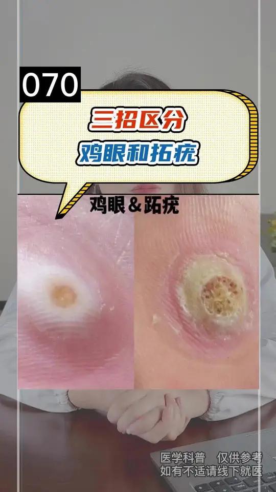 三招教你区分鸡眼和跖疣