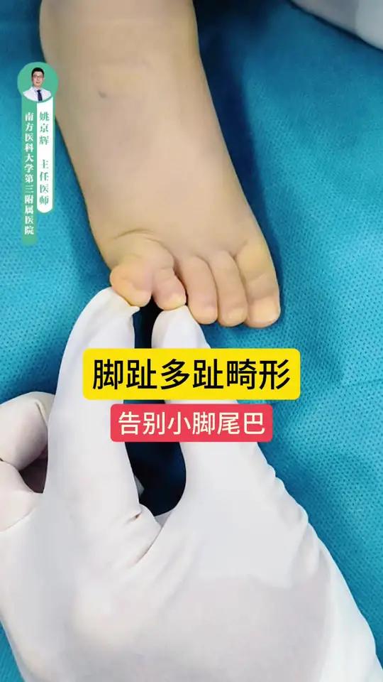 脚趾多趾畸形 告别小趾小尾巴 宝宝出生小脚多了个小脚趾,是先天性多趾畸形。奶奶觉得小就不用